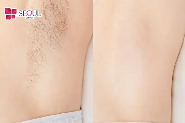Công nghệ triệt lông DPL mang lại hiệu quả cao, an toàn nhưng còn tùy thuộc vào màu lông, màu da, độ dày của lông vùng triệt