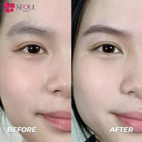 Khách hàng trước và sau khi điêu khắc chân mày 8D tại Seoul Center với sự thay đổi rõ rệt: hàng mày cân đối, sắc nét nhưng vẫn tự nhiên.