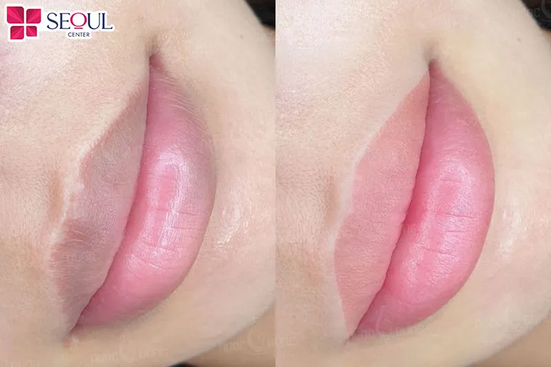 Khách hàng tự tin hơn hẳn với đôi môi hồng hào, tự nhiên
