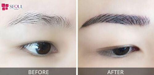 Cấy lông mày tự thân giúp khắc phục chân mày thưa, mang lại hàng mày chữ nhất tự nhiên với các sợi lông thật mọc theo dáng đã thiết kế.
