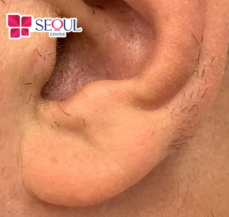Lông mọc ở tai trái thường có con đường sự nghiệp suôn sẻ, có quý nhân phù trợ, dễ gặt hái thành công