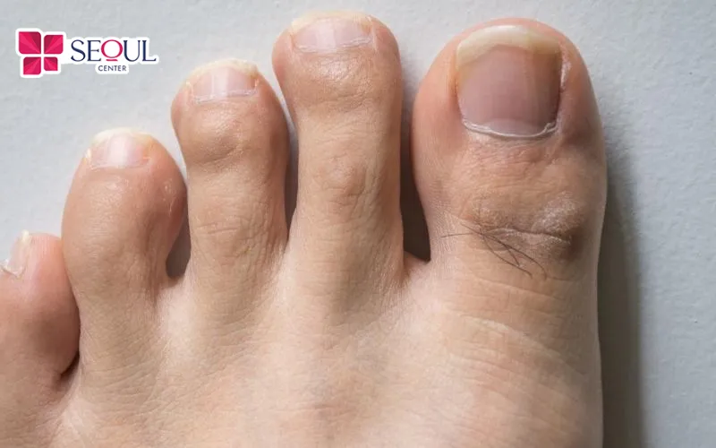 Mọc lông ngón chân cái ở cả nam và nữ đều mang ý nghĩa liên quan đến phúc khí tốt