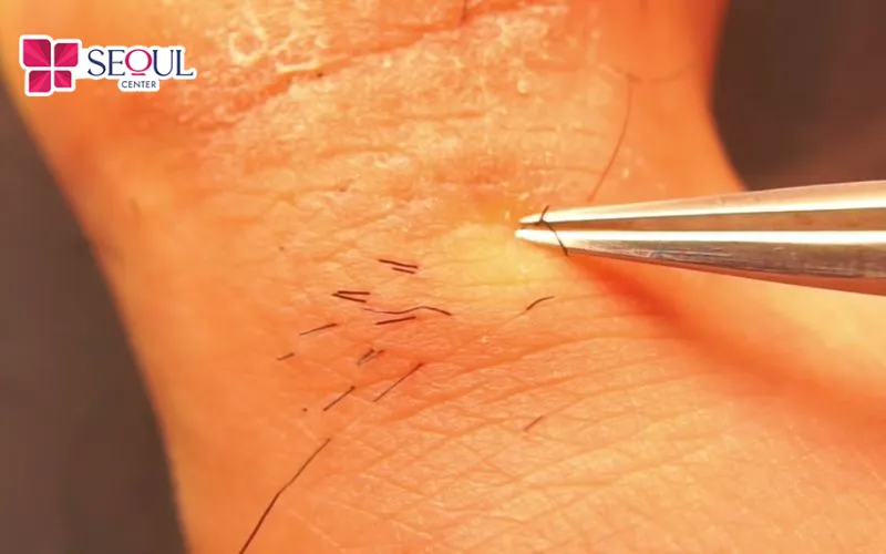 Nhổ lông mọc ở ngón chân cái thường không gây kích ứng, viêm nhiễm như sử dụng tẩy lông hóa học