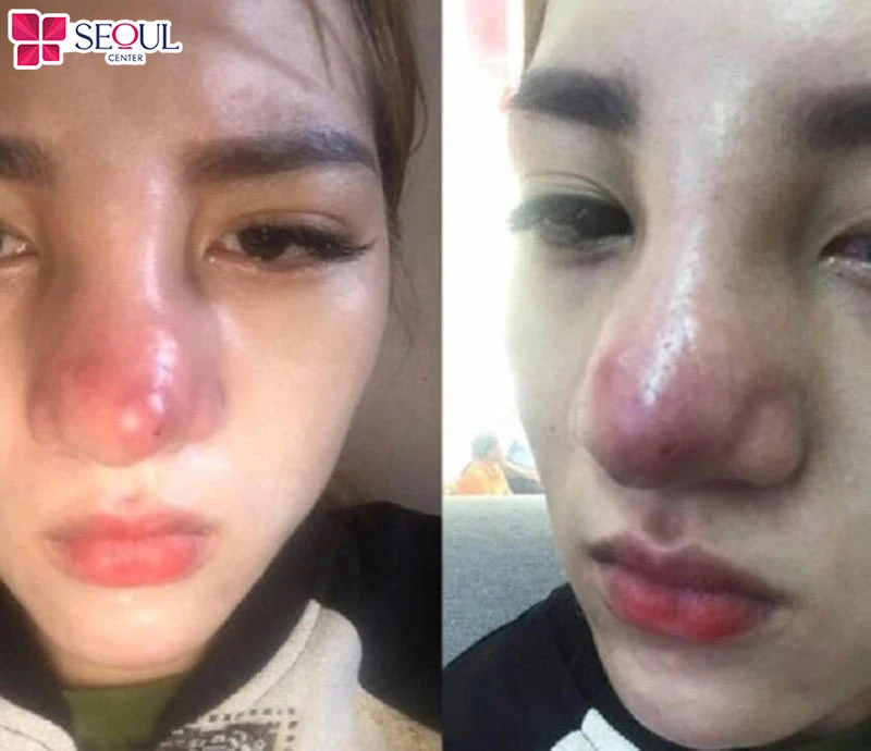 Lựa chọn cơ sở thẩm mỹ kém uy tín có thể làm tăng nguy cơ gặp các biến chứng làm ảnh hưởng nghiêm trọng đến kết quả thẩm mỹ