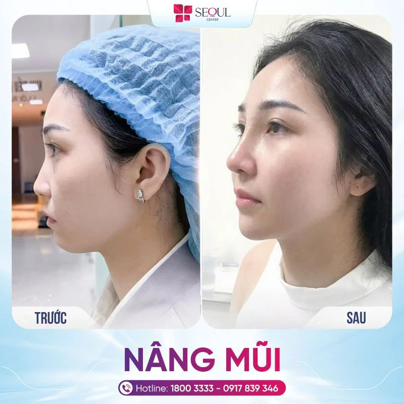 Nên tìm đến những cơ sở uy tín, có đội ngũ bác sĩ thẩm mỹ giỏi để thực hiện dịch vụ nâng mũi