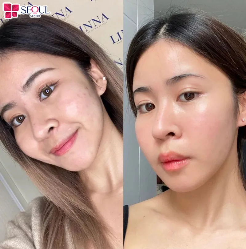 Làn da khách hàng sau khi tiêm Rejuran Healer căng mướt, mềm mịn, trẻ hóa toàn diện
