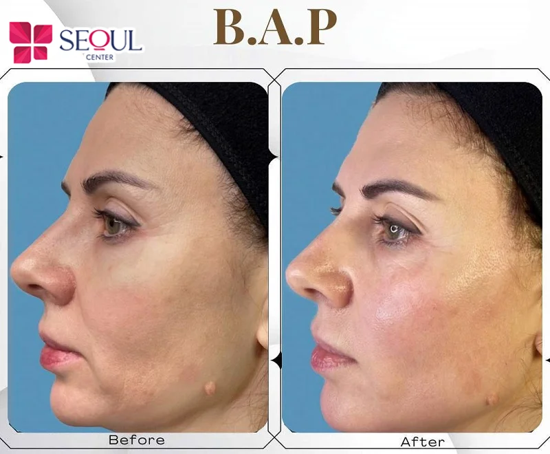 Làn da sau khách hàng căng mịn, ẩm mượt và đều màu hơn sau khi DoublyX Evo bằng kỹ thuật tiêm B.A.P