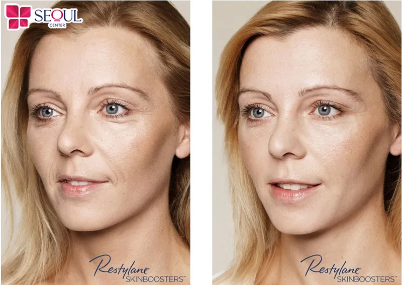 Restylane Vital Light giúp da sáng, đều mịn, giảm nếp nhăn giúp gương mặt trẻ trung và tươi sáng hơn