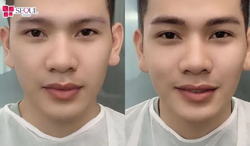 Chân mày che khuất ấn đường làm suy giảm vận khí và cản trở con đường công danh