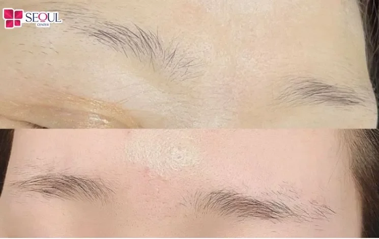 Di truyền, rối loạn nội tiết tố và tác động cơ học sai cách là nguyên nhân chính khiến chân mày thưa mảnh và dễ gãy rụng