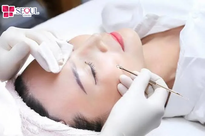Chăm sóc hậu nặn mụn đúng khoa học giúp vết thương lành nhanh sau vài ngày