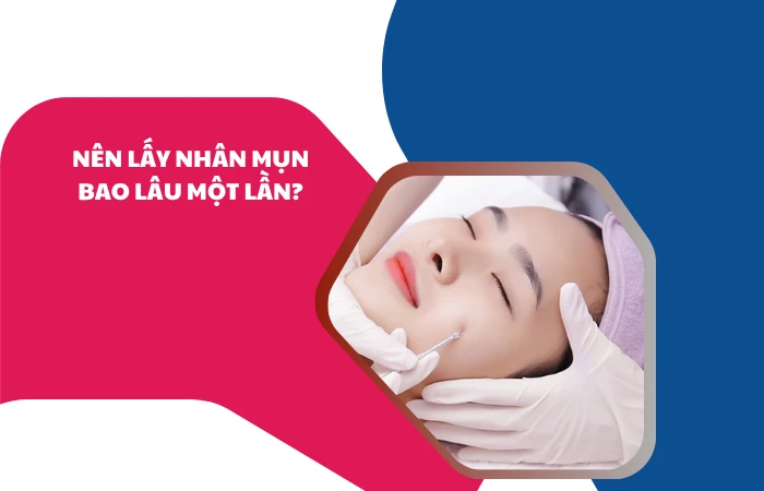 Nên lấy nhân mụn bao lâu một lần