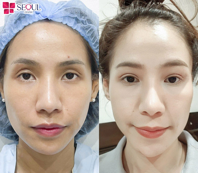 Kết quả nhấn mí Plasma có thể duy trì 3-5 năm