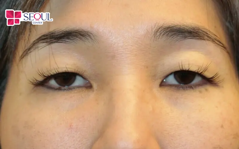 Nhổ tỉa chân mày sai kỹ thuật không chỉ góp phần gây sụp mí mà còn tiềm ẩn nguy cơ viêm nhiễm da
