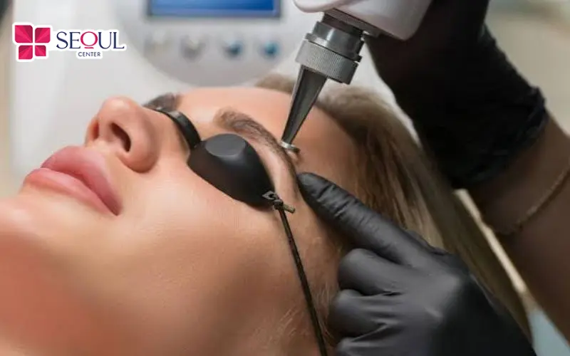 Ứng dụng công nghệ laser giúp khắc phục hiệu quả hiện tượng nhổ lông mày bị sụp mí