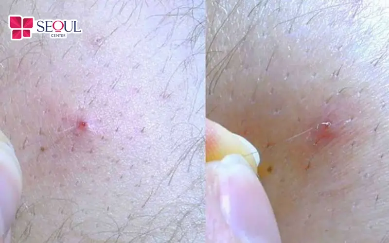 Tình trạng lông nách mọc ngược và thô cứng xuất phát từ thao tác dùng nhíp sai kỹ thuật