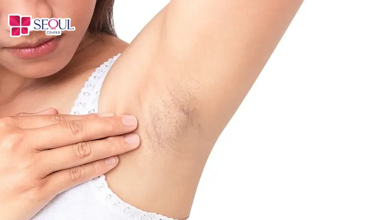Lông nách hình thành mạnh mẽ vào giai đoạn dậy thì do sự biến đổi hormone nội tiết