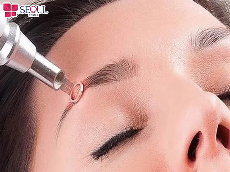 Xóa xăm chân mày bằng laser phù hợp với nhiều đối tượng