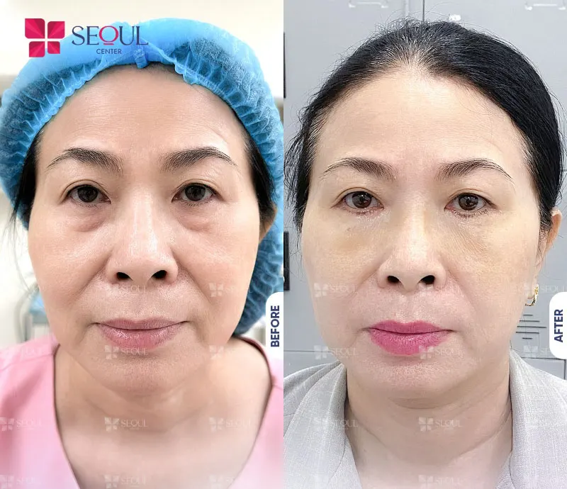 Mắt cân đối, trẻ trung hơn mang đến cho khách hàng cảm giác tự tin