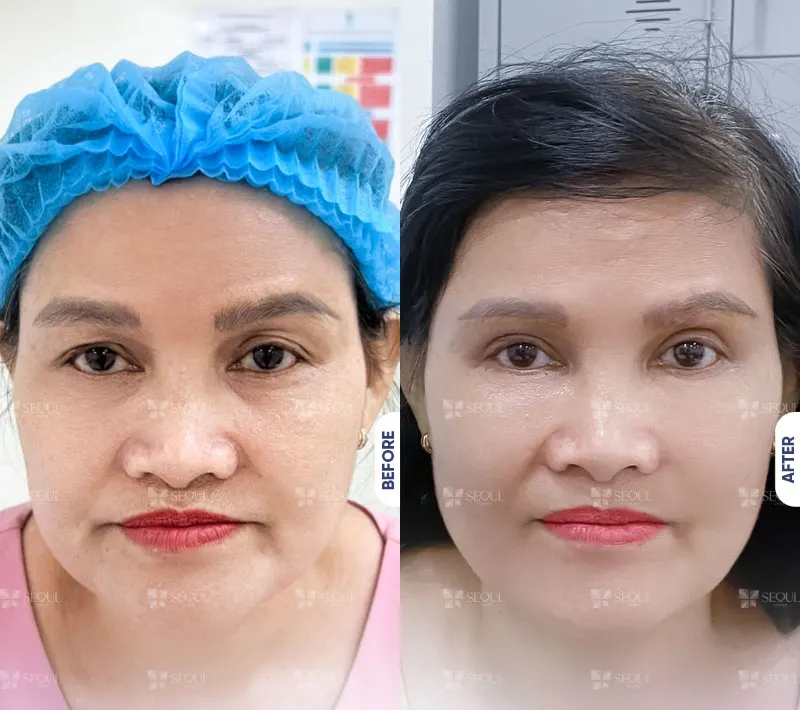 Tình trạng mỡ thừa, bọng mắt mi dưới được khắc phục hoàn toàn