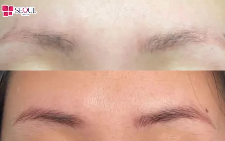 Lông mày bị cháy hoàn toàn có thể mọc lại bình thường nếu mức độ tổn thương tương đối nhẹ