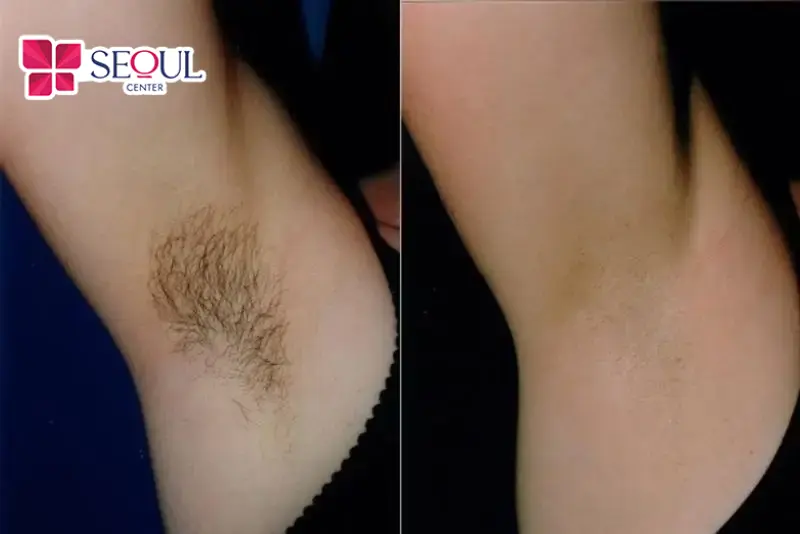 Bạn nên kiên trì thực hiện các phương pháp tự nhiên để thấy hiệu quả rụng lông rõ rệt