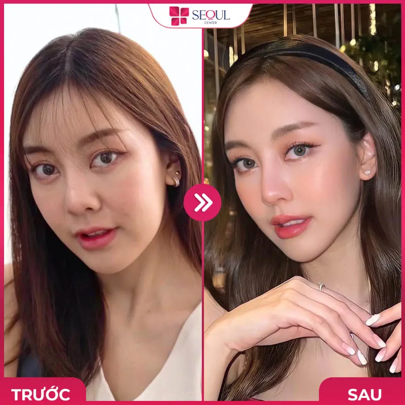 Thu nhỏ đầu mũi có thể khắc phục mũi to lâu dài