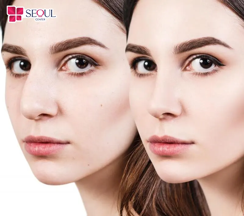 Sụn tự thân có thể giúp cải thiện nhiều nhược điểm dáng mũi Sụn tự thân có thể giúp cải thiện nhiều nhược điểm dáng mũi
