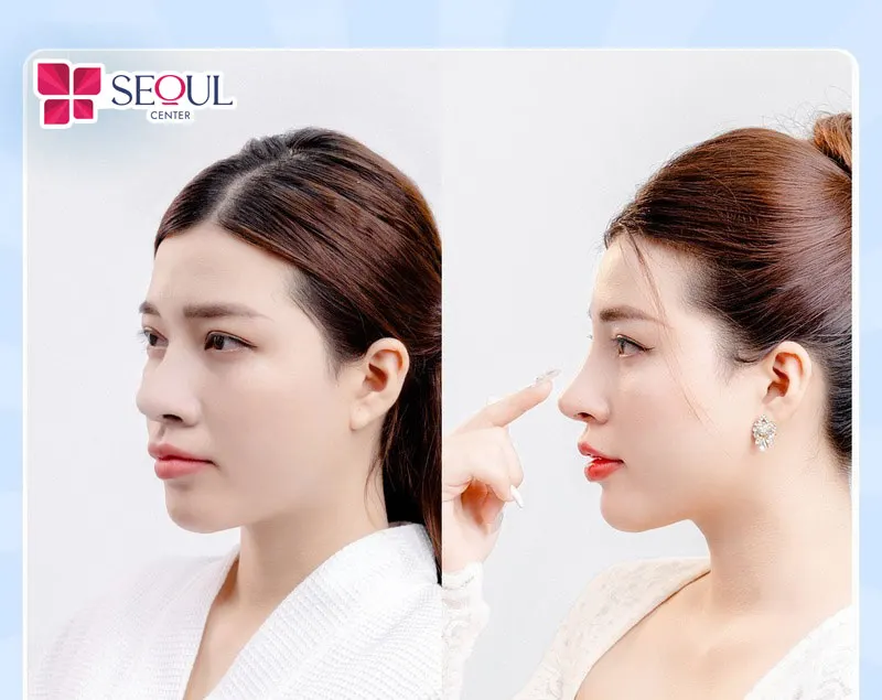 Dáng mũi cao thẳng, tự nhiên sau khi nâng mũi tự thân tại Seoul Center