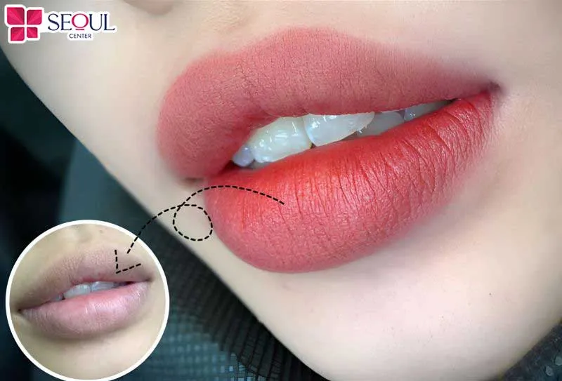 Thực hiện dặm môi tại cơ sở thẩm mỹ uy tín giúp bạn sở hữu bờ môi tươi tắn an toàn