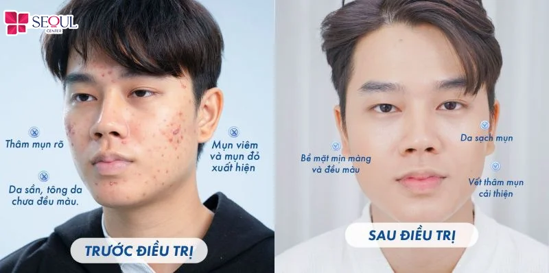Khách hàng nam trước và sau khi trị mụn tại Seoul Center, cho thấy hiệu quả cải thiện làn da và năng lực điều trị mụn chuyên sâu của thương hiệu.