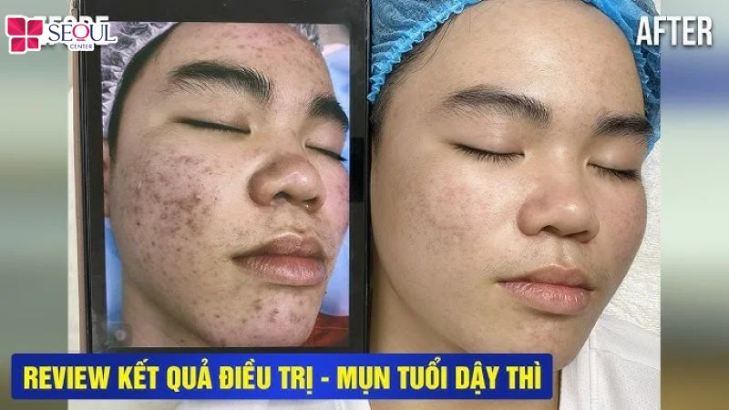 Khách hàng nam điều trị mụn bằng công nghệ ánh sáng sinh học hiện đại tại Hiền Vân Spa