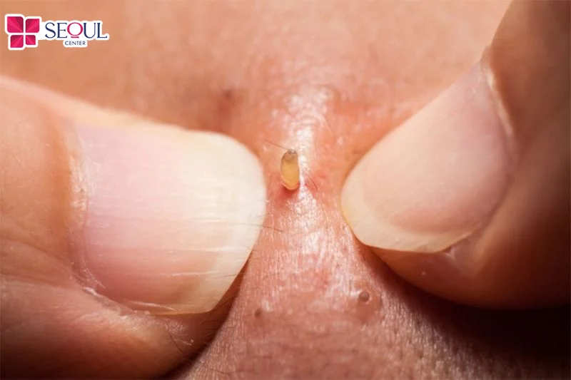Nặn mụn bằng tay dễ làm tổn thương da, tăng nguy cơ viêm nhiễm, sẹo và khiến mụn tái phát.