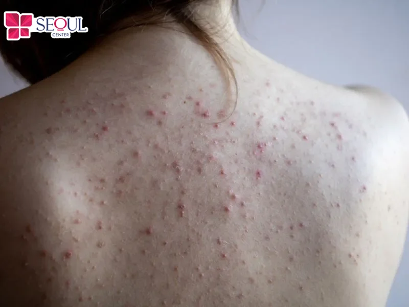 Làn da bị mụn viêm nặng đòi hỏi phác đồ điều trị chuyên sâu và số buổi trị liệu nhiều hơn