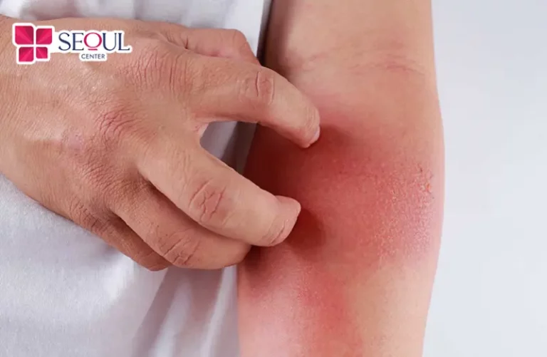 Công nghệ cũ hoặc kỹ thuật viên điều chỉnh sai bước sóng là nguyên nhân khiến da bị đau rát.
