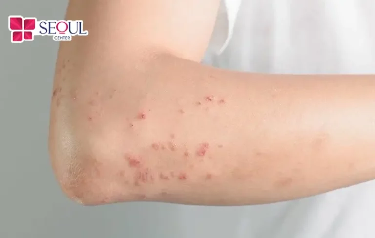 Da có thể bị kích ứng mẩn đỏ nhẹ sau khi triệt nhưng sẽ tự hết sau vài giờ