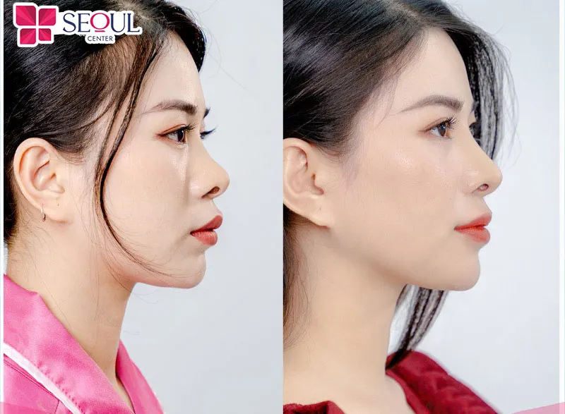 Để chọn được dáng mũi ưng ý cần cân nhắc và chọn lọc kỹ trước khi quyết định