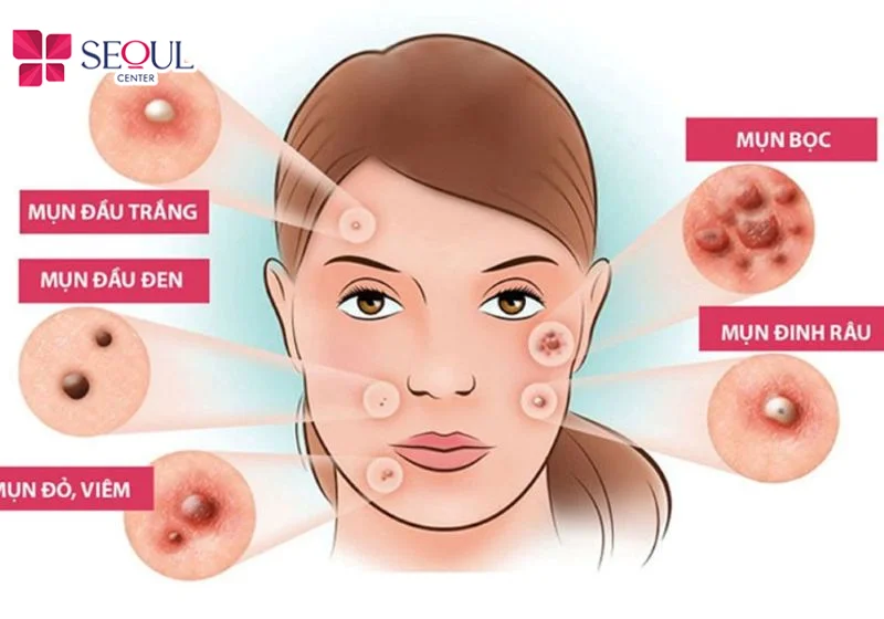 Chi phí 1 liệu trình trị mụn tại spa dao động tùy thuộc vào tình trạng mụn thực tế