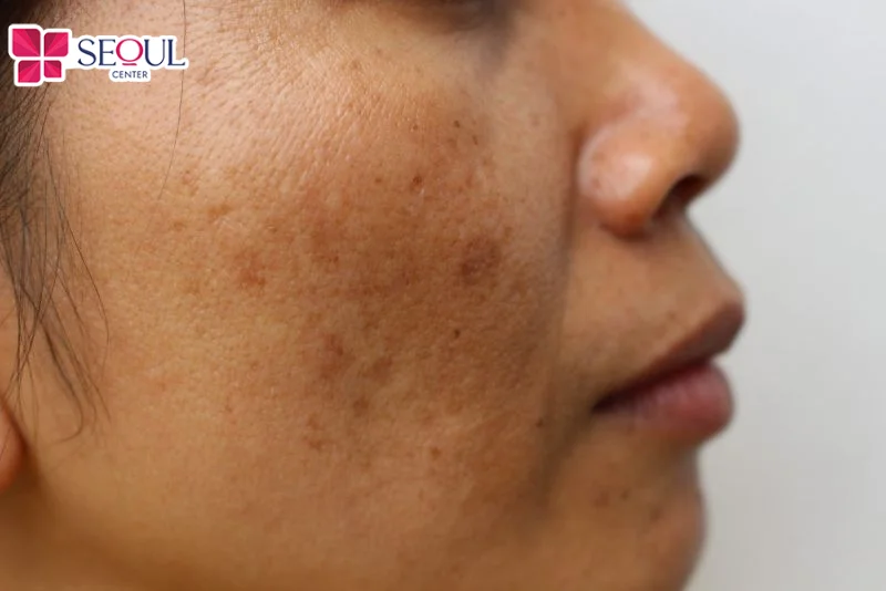 Việc chọn spa giá rẻ kém chất lượng ẩn chứa nguy cơ gây thâm sẹo và bùng phát mụn