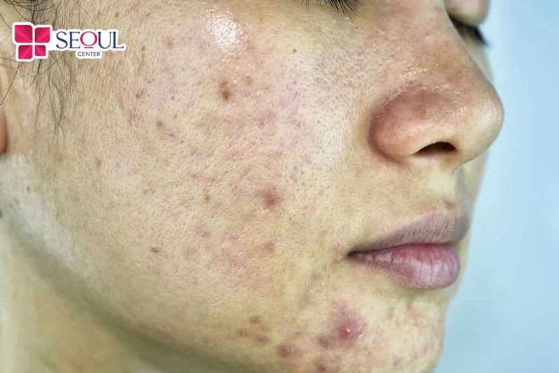 Vào mùa hè da dầu mụn thường tăng tiết nhờn quá mức, gây bít tắc lỗ chân lông, vi khuẩn sinh sôi, dễ hình thành mụn