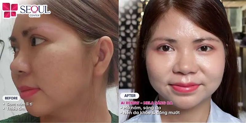 Liệu trình AI Renew - Mela sáng da sở hữu nhiều ưu điểm vượt trội được nhiều khách hàng tại Seoul Center yêu thích và hài lòng sau khi sử dụng