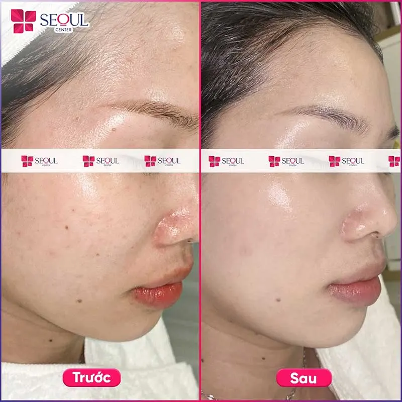 Tình trạng da kém sắc, xỉn màu của khách hàng đã được khắc phục sau liệu trình AI Renew - Mela sáng da