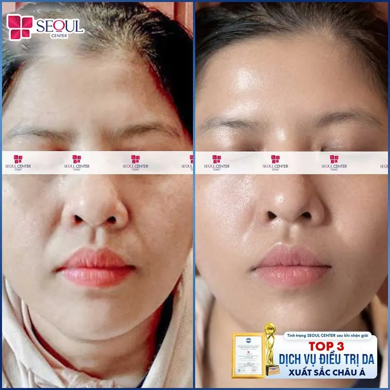 Da khách hàng sáng mịn, đủ ẩm, đều màu hơn sau liệu trình AI Renew - Mela sáng da