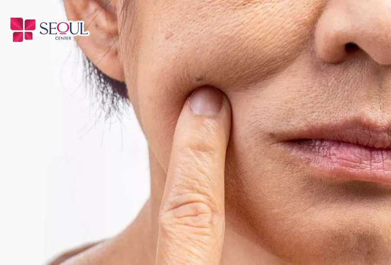 Những ai có những nếp nhăn li ti, rãnh cười sâu, da khô ráp, thiếu sức sống, có sẹo nông rất phù hợp áp dụng dịch vụ B.A.P Karisma – RH Collagen