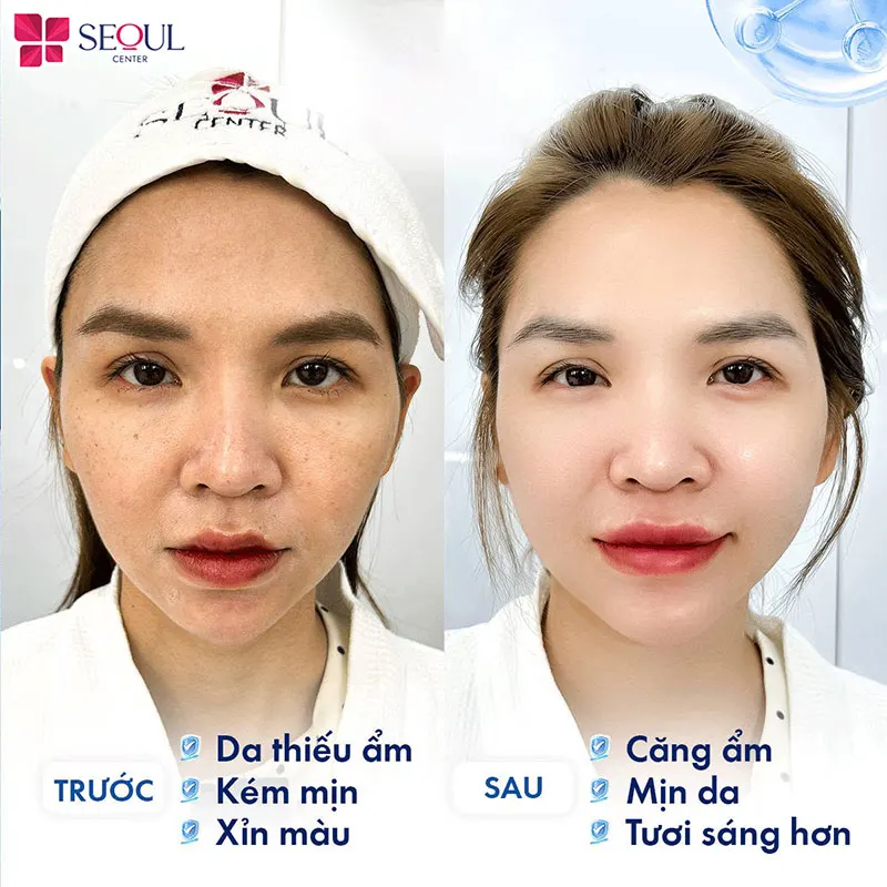 Liệu trình tiêm B.A.P Xcelen Genyal phù hợp với da thiếu ẩm, khô ráp, kém mịn màng, xỉn màu