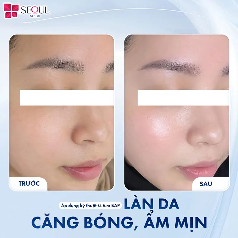 Sau liệu trình tiêm B.A.P Xcelen Genyal làn da khách hàng trở nên căng bóng, ẩm mịn, tươi tắn hơn