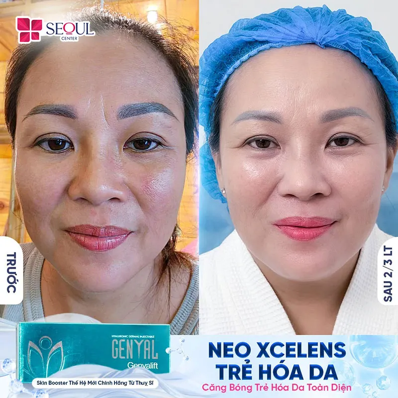 Làn da có nếp nhăn li ti, kém đàn hồi, thiếu cứ sống, khô ráp của chị khách đã được được khắc phục sau khi tiêm B.A.P Xcelen Genyal
