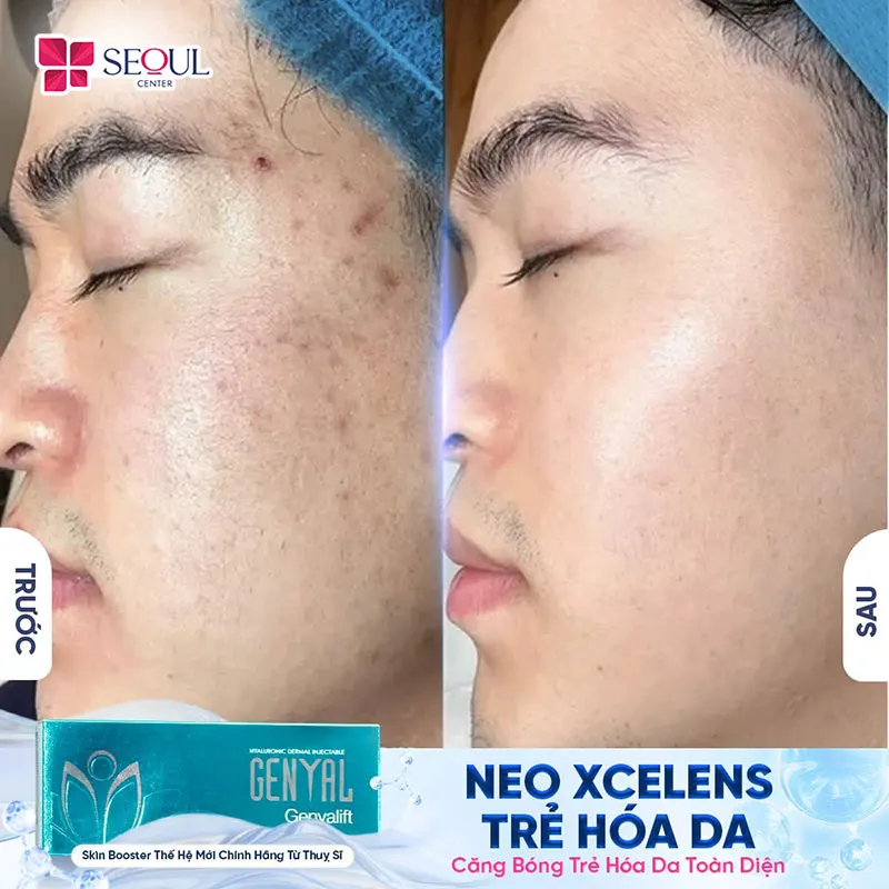 Hình ảnh làn da khách hàng được cải thiện độ ẩm và mịn màng hơn sau khi tiêm B.A.P Xcelen Genyal