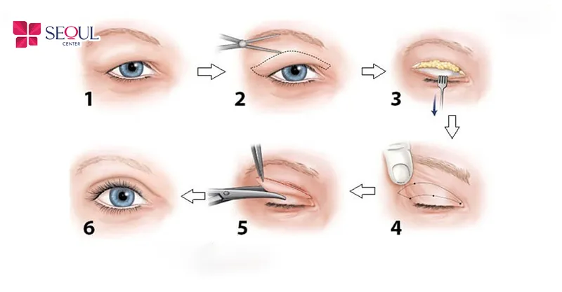 Cắt Mí Trên giúp loại bỏ da chùng nhão, chảy xệ, bọng mỡ thừa, tạo nếp mí rõ nét, cân đối cho khách hàng