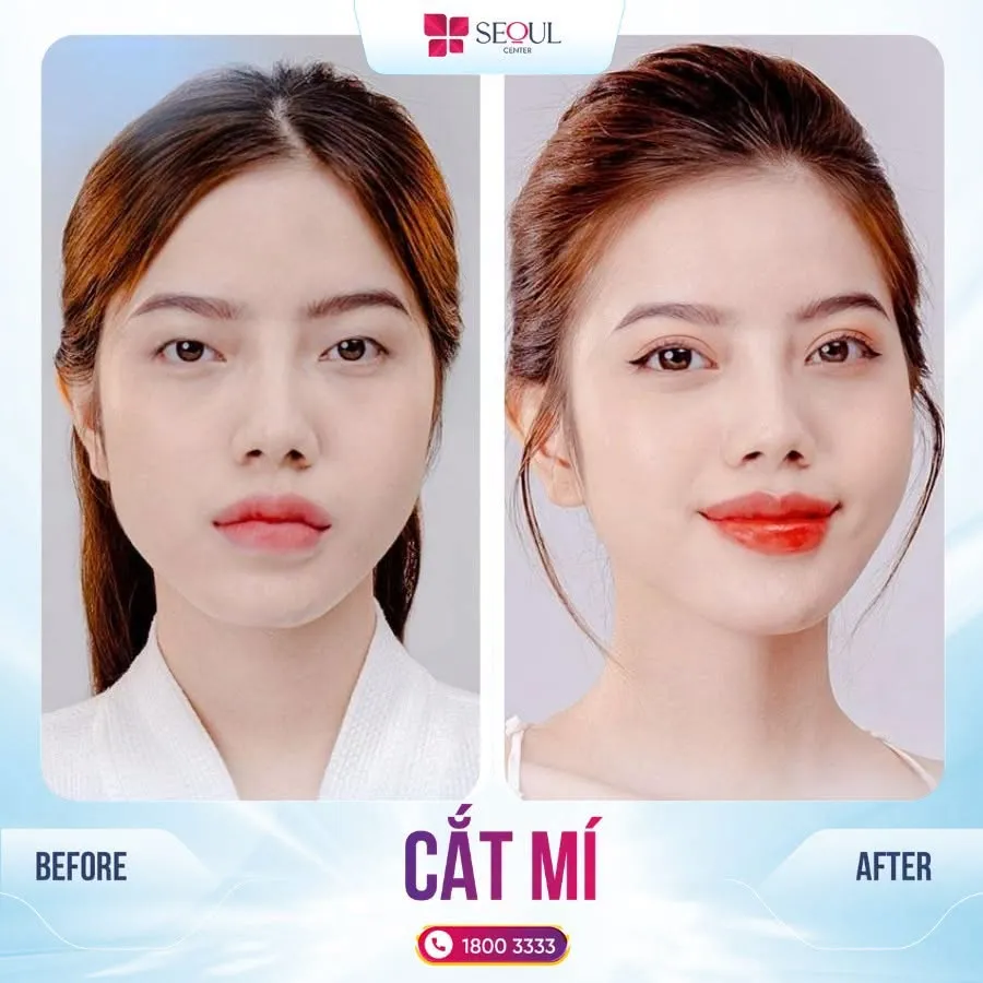 Cắt Mí Trên là giải pháp duy trì hiệu quả lâu dài, tạo nếp mí rõ, đẹp, tự nhiên cho khách hàng